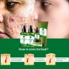 Private Label Facial Care Tea Tree Oil Anti Acne Face Set Toner Cream Serum Acne Treatment Skin Care Set