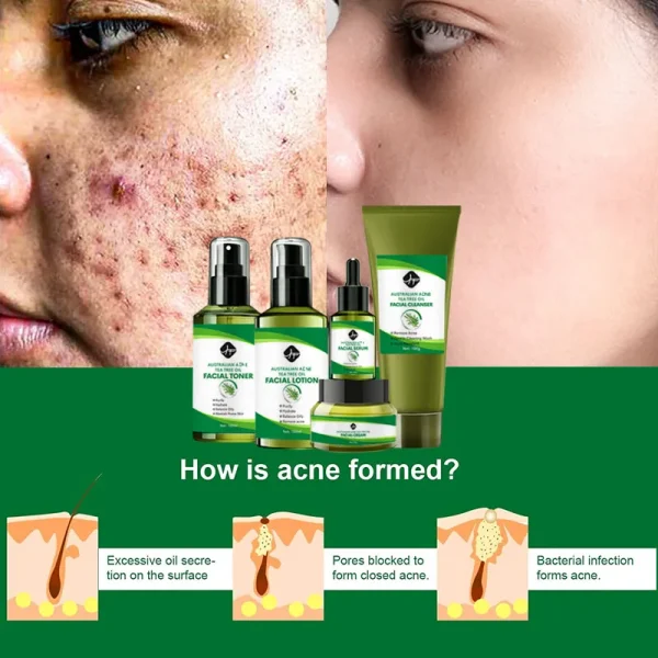 Private Label Facial Care Tea Tree Oil Anti Acne Face Set Toner Cream Serum Acne Treatment Skin Care Set